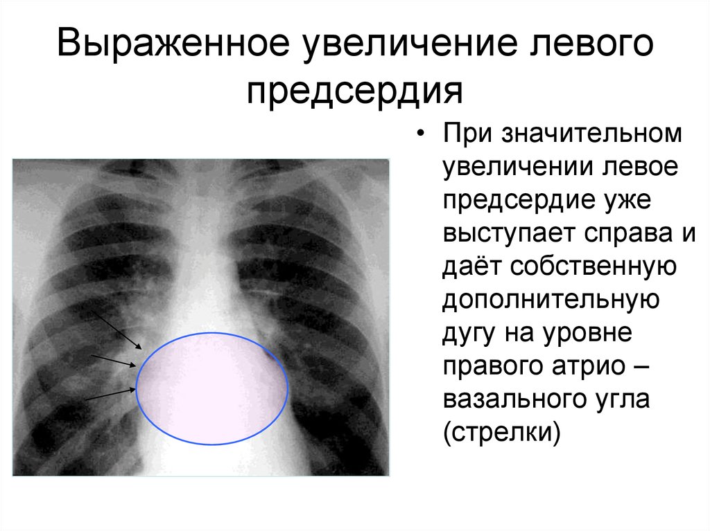 Увеличено левое. Дилатация левого предсердия. Умеренная дилатация левого предсердия. Дементация левого предсердия. Расширение левого предсердия.