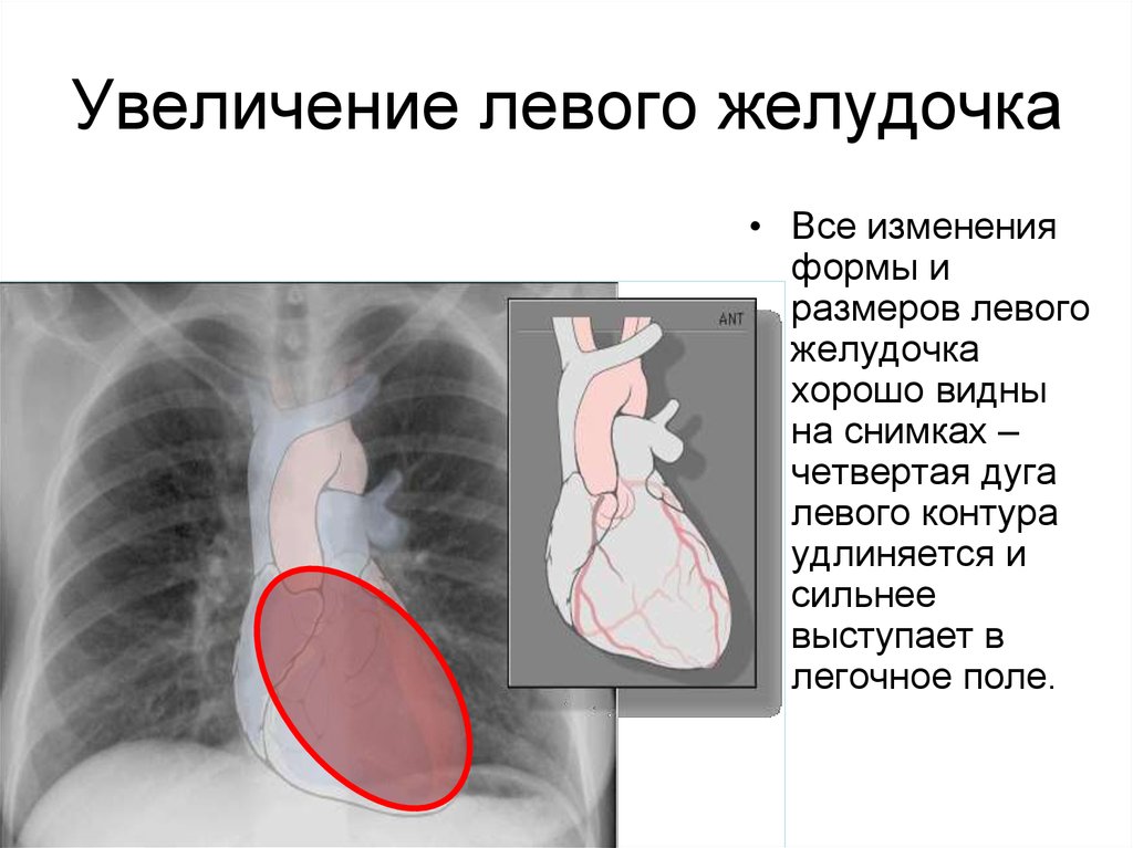 Желудочка сердца расширена. Увеличение левого желудочка. Расширение желудка в сердце. Увеличен левый желудочек. Увеличение левого желудочка на рентгене.