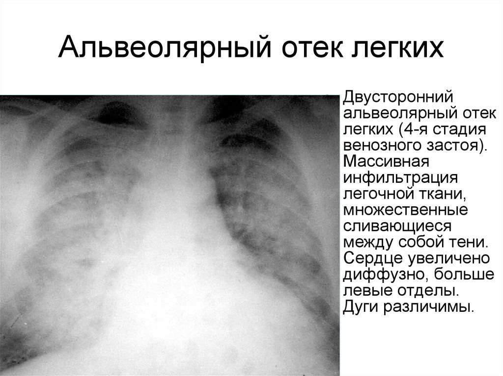 Отек легкого презентация