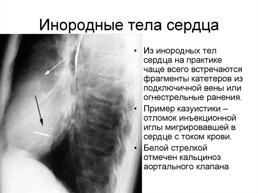 Инородное тело. Огнестрельное ранение формулировка диагноза. Пример формулировка диагноза огнестрельное ранение. Диагноз пулевое ранение.