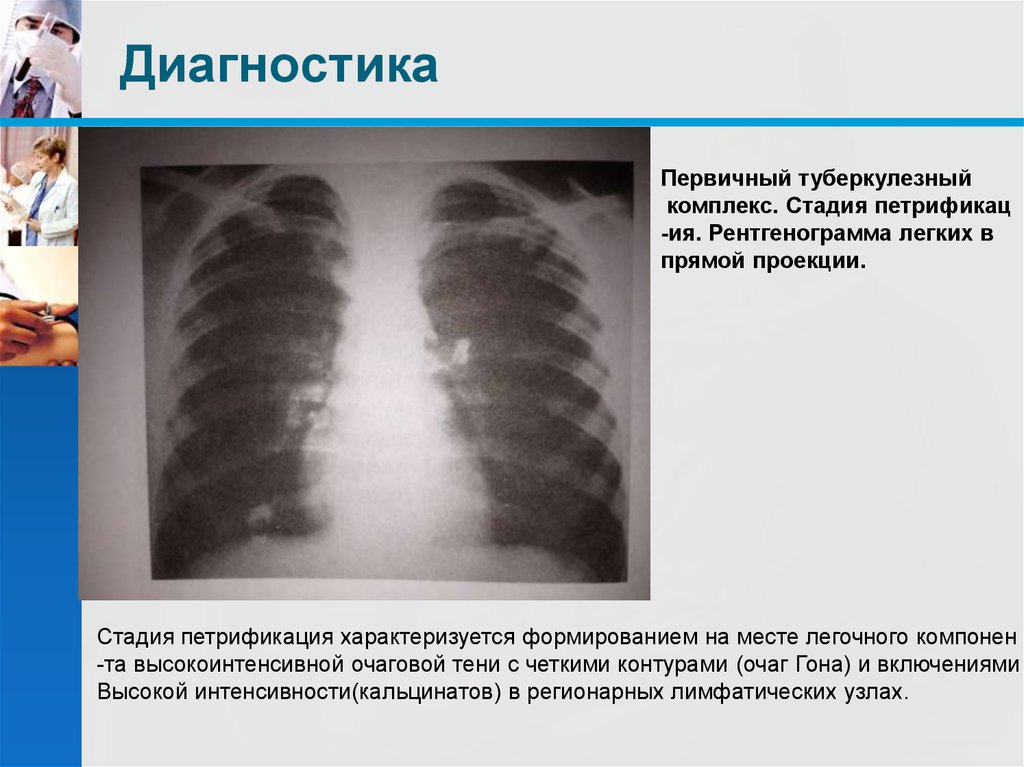 Первичный туберкулезный комплекс презентация