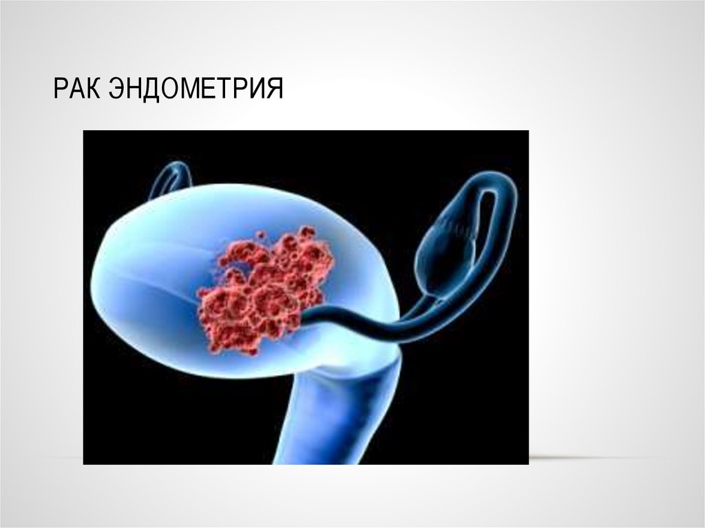 Лечение рака эндометрия