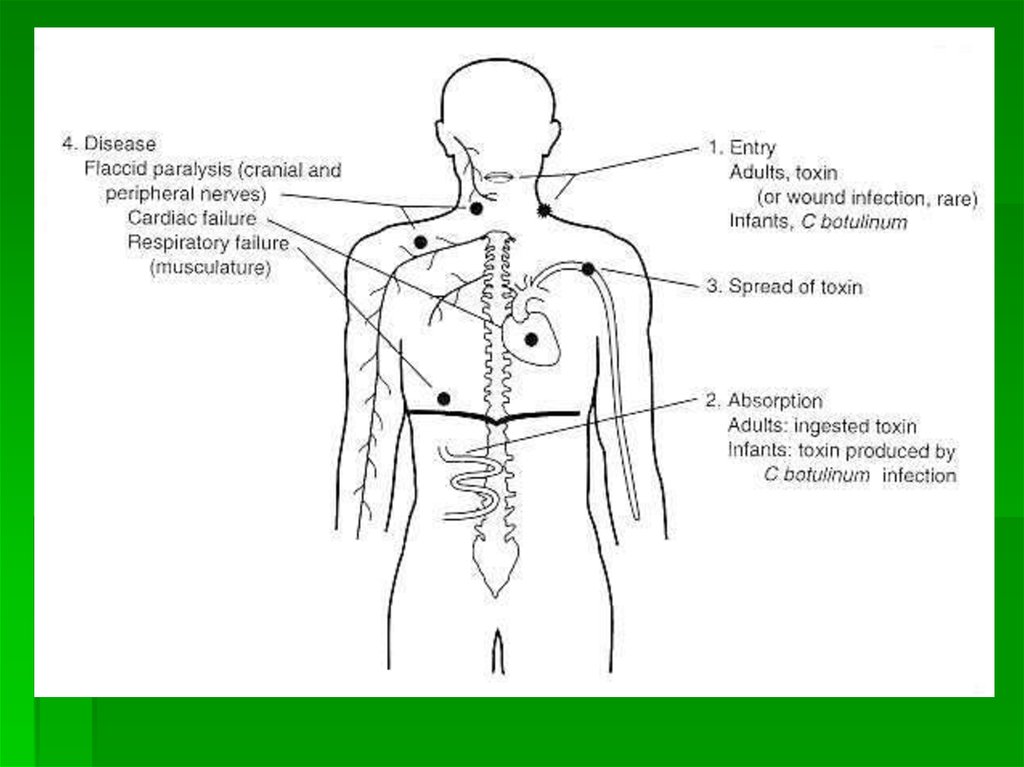 Патогенез ботулизма картинки