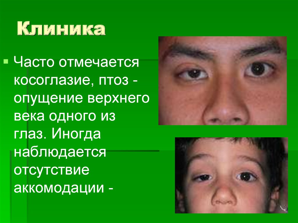 Симптомы ботулизма. Ботулизм клиника. Ботулизм симптомы. Клиника ботулизма кратко.