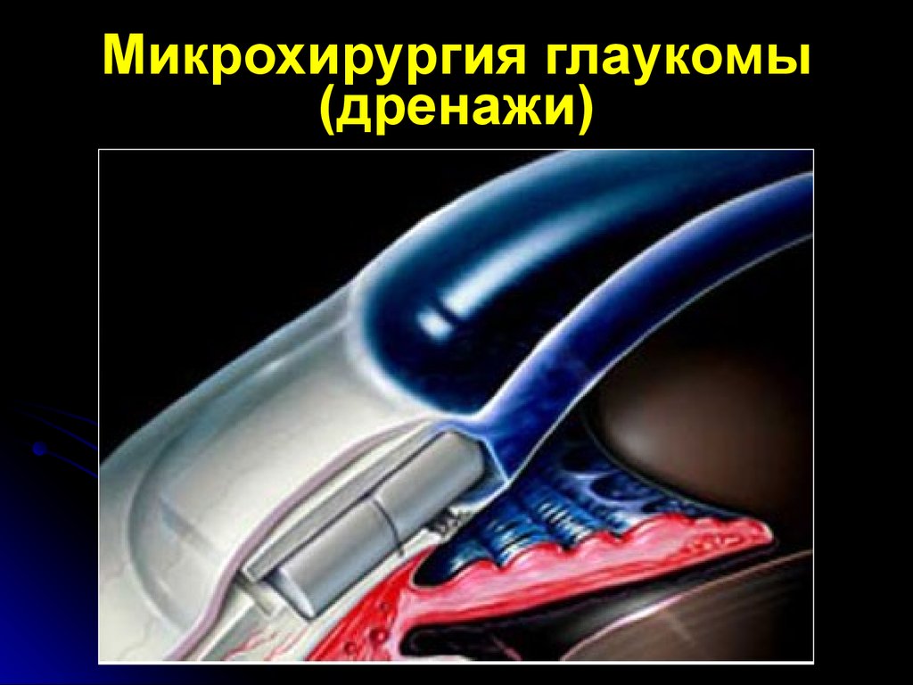 Гидродинамика глаза. Нарушение гидродинамики глаза. Причины нарушения гидродинамики глаза. Гидродинамика глаукомы.