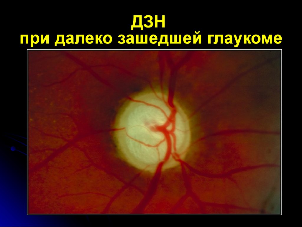 Норма зрительного нерва. Оптическая когерентная томография зрительного нерва. Экскавация диска зрительного нерва окт. Оптическая когерентная томография (окт) диска зрительного нерва.