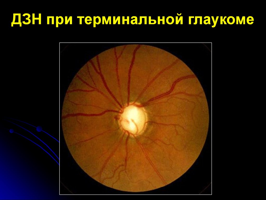 Норма зрительного нерва. Экскавация диска зрительного нерва. Глаукомная экскавация зрительного нерва. Оптическая когерентная томография диска зрительного нерва. Глаукома диск зрительного нерва.