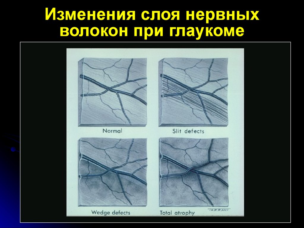 Измененный слой. Нарушение гидродинамики глаза при глаукоме. Изменение слоя нервных волокон. Нервные волокна при глаукоме. Гидродинамика глаза при глаукоме.