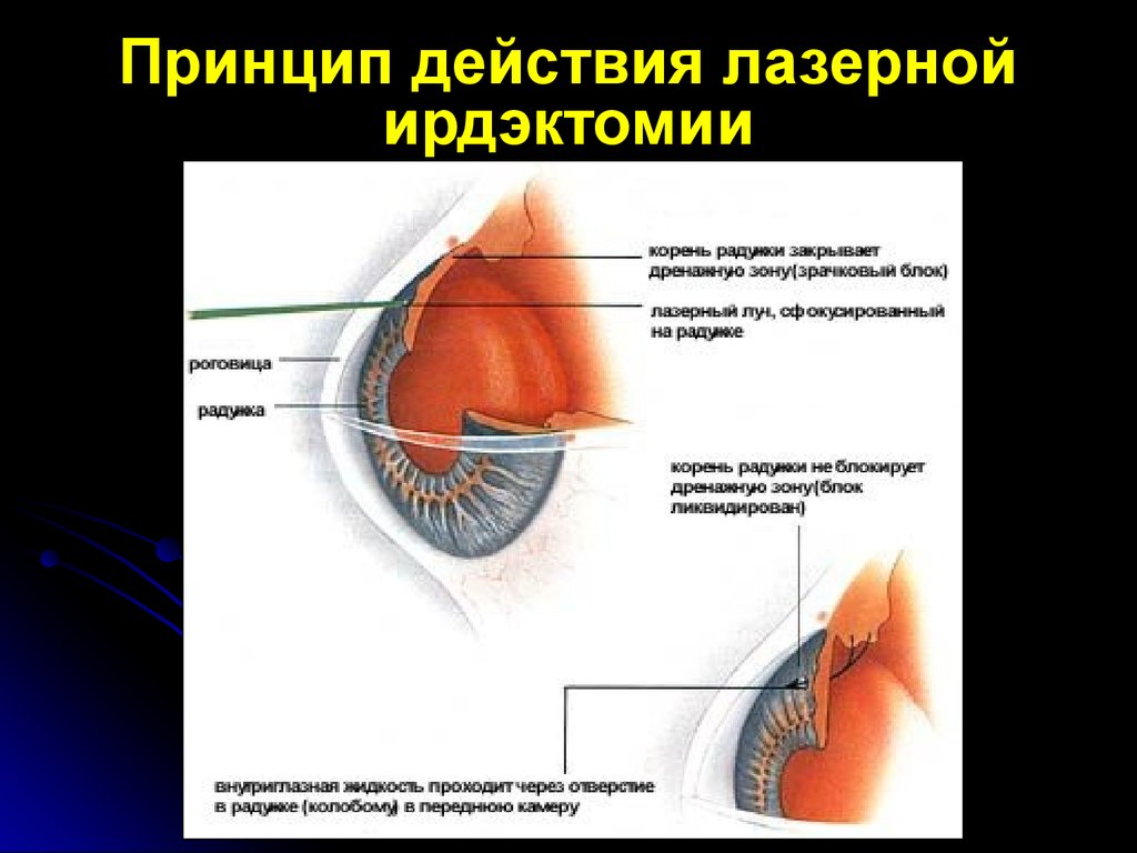 Гидродинамика глаза. Лазерная иридэктомия при глаукоме. Гемо и гидродинамики глаза. Нарушение гидродинамики глаза. Лазерная десцеметогониопунктура.