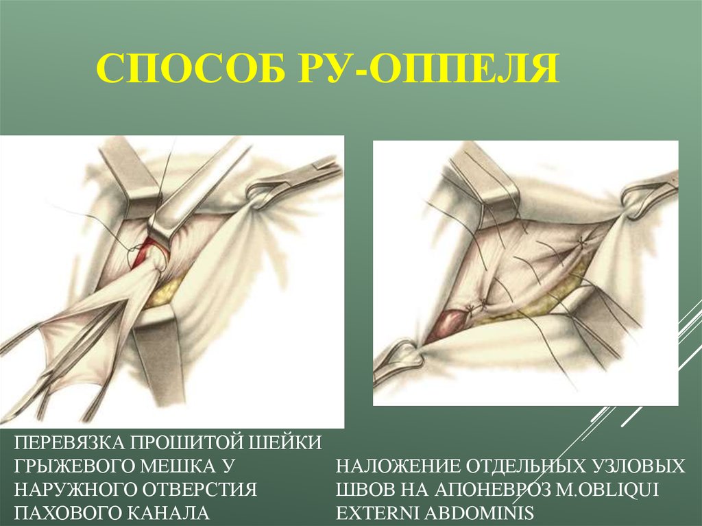 Перевязка аккаунта. Перевязка шейки грыжевого мешка. Прошивание шейки грыжевого мешка. Ушивание дефекта апоневроза. Пластика пахового канала.