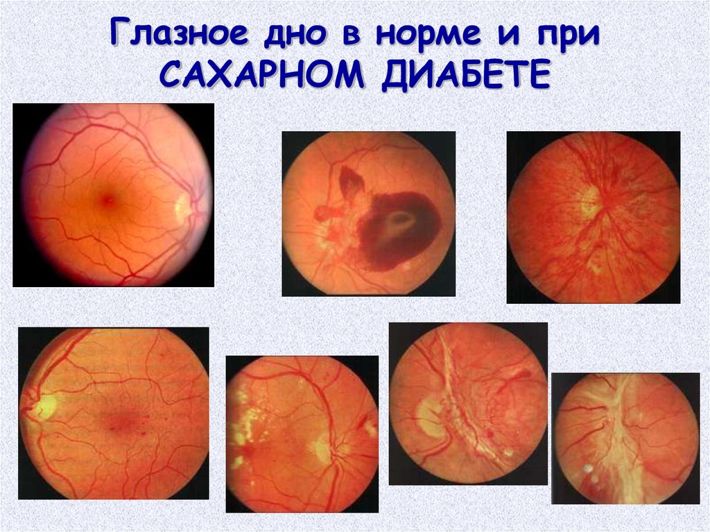 Норма глазного дна. Офтальмоскопия глазного дна. Осмотр глазного дна норма. Офтальмоскопия глазного дна норма. Глазное дно при сахарном диабете и в норме.