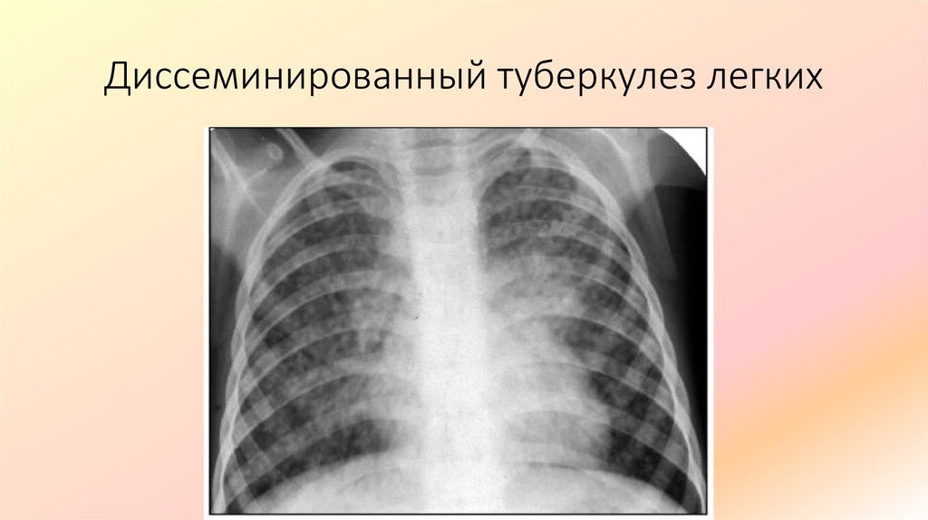 Врожденный туберкулез. Подострый диссиминированный туберкулёз рентген. Милиарный туберкулез рентген. Инфильтративный туберкулез рентгенография. Подострый диссеминированный туберкулез рентген.