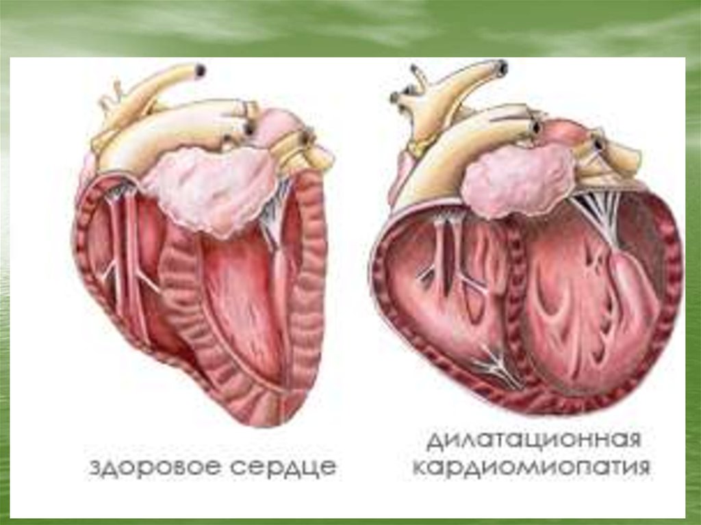 Поражение сердца без застойной сердечной. Бычье сердце кардиомиопатия. Дилатационная гипертрофия миокарда. Дилатационная кардиомиопатия.