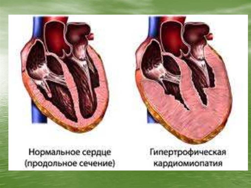 Миокард правого желудочка сердца. Дилатационная кардиомиопатия макропрепарат. Кардиомиопатия и миокардиодистрофия. Миокардиодистрофия синдром пивного сердца. Гипертрофия миокарда сердца.