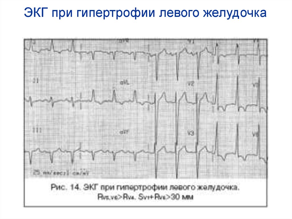 Картина экг при гипертрофии левого желудочка