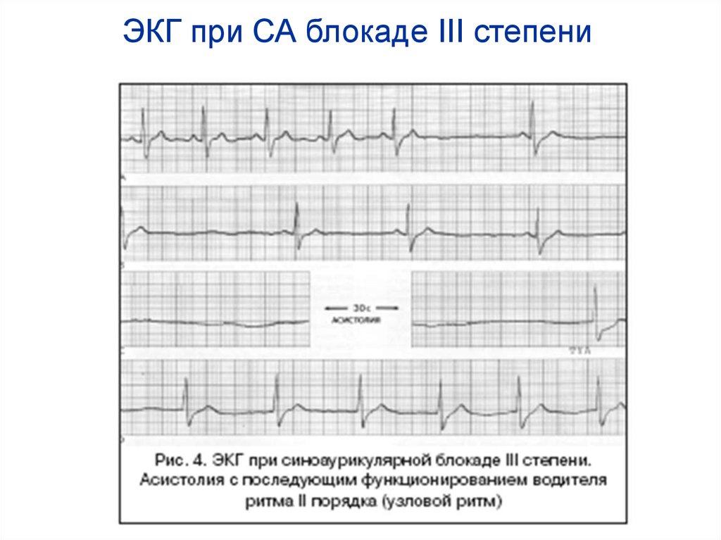 Экг 3. ЭКГ при синоатриальной блокаде 3 степени. Синусовая блокада 2 степени ЭКГ. Синоаурикулярная блокада III степени. Синоаурикулярная блокада 1 степени на ЭКГ.