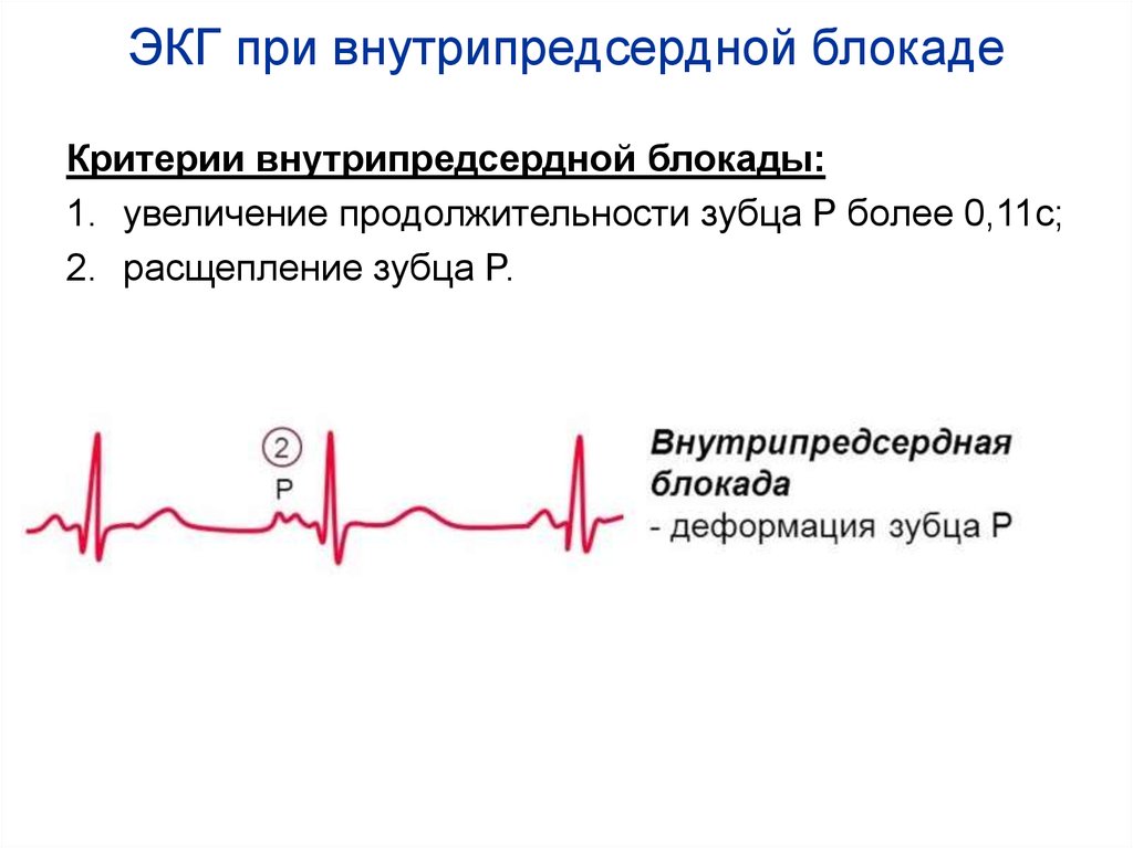 ЭКГ при внутрипредсердной блокаде