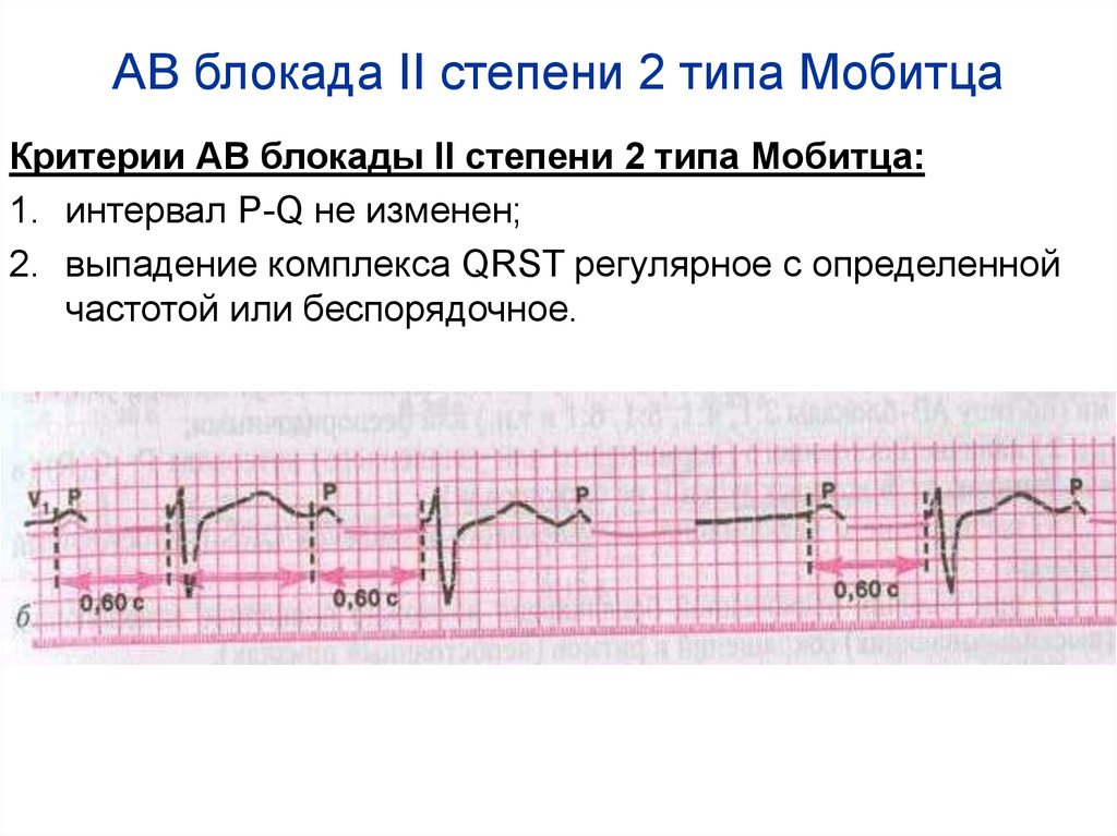 АВ блокада II степени 2 типа Мобитца