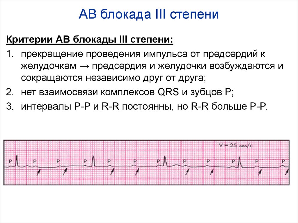 Ав блокада 3 степени на экг картинки