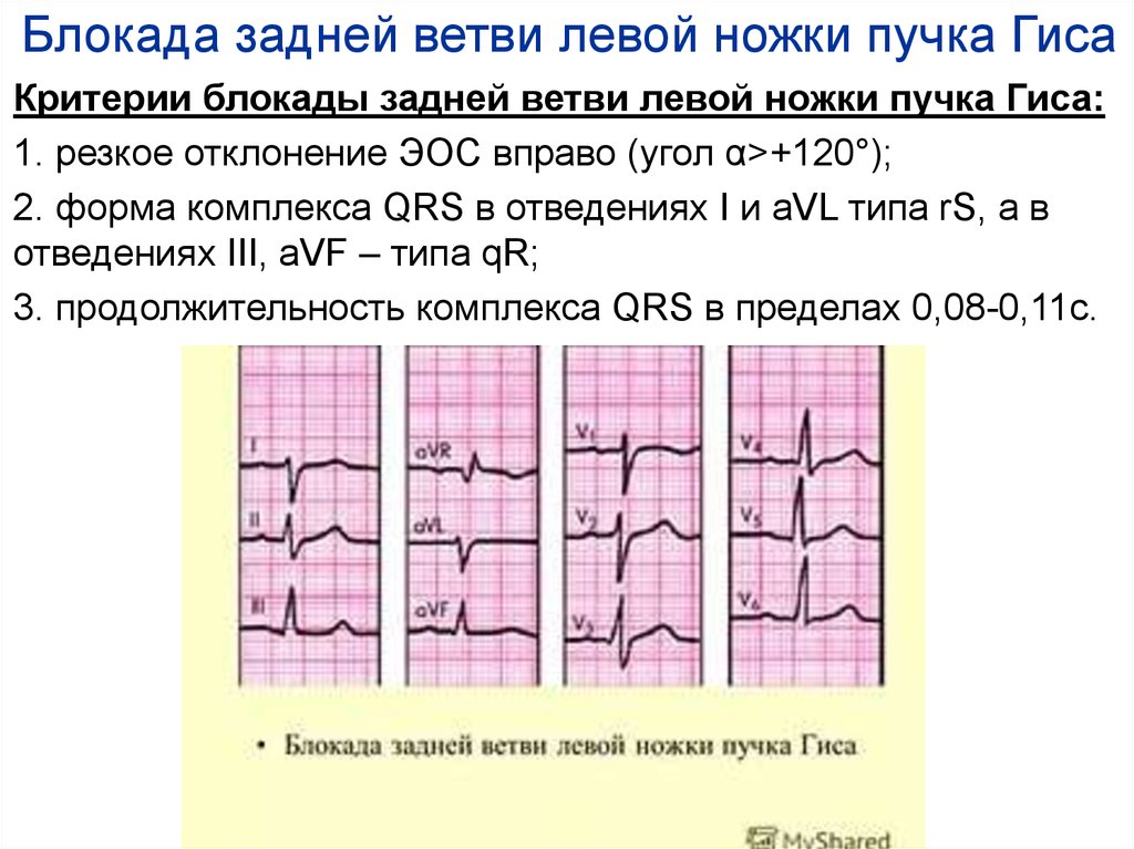 Полная блокада левой ножки. Неполная блокада задней ветви ЛНПГ. Блокада задней ветви левой ножки пучка Гиса на ЭКГ признаки. Блокада задней ветви ЛНПГ на ЭКГ. Блокада задней ветви левой ножки пучка Гиса на ЭКГ.