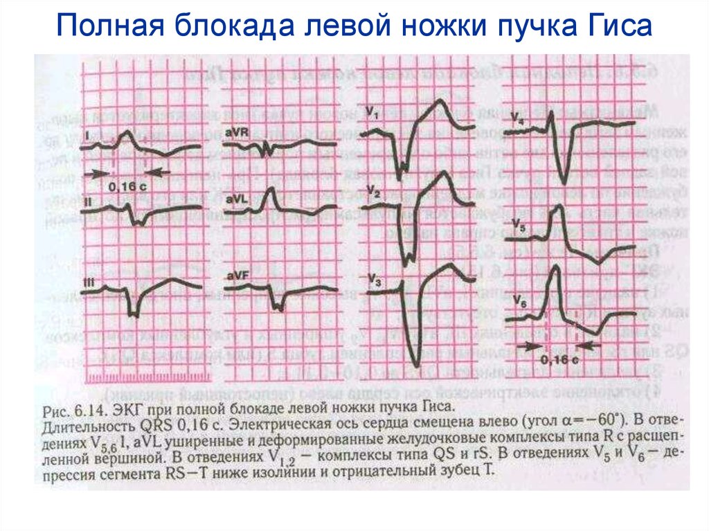 Левой ножки пучка. Блокада левой ножки пучка Гиса на ЭКГ. ЭКГ при блокаде левой ножки пучка Гиса. Блокада ножек пучка Гиса на ЭКГ. ЭКГ при полной блокаде пучка Гиса.