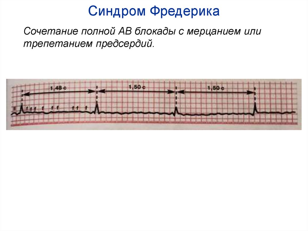 Синдром Фредерика