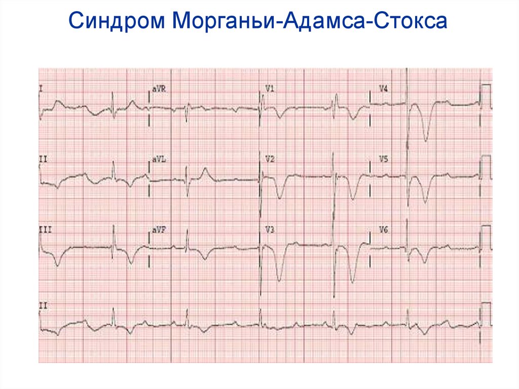 Синдром морганьи адамса стокса презентация