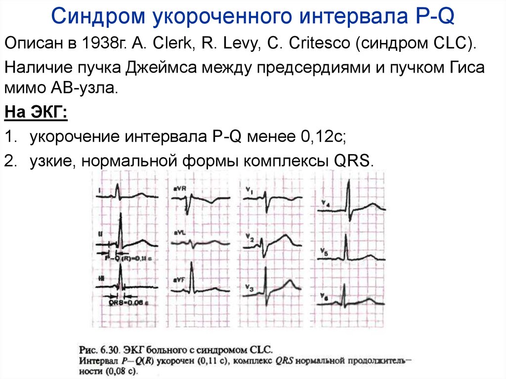 Pq на экг. Синдром укорочения интервала PQ на ЭКГ. Синдром укороченного интервала PQ симптомы. Укороченный интервал PQ на ЭКГ. Синдром Клерка-Леви-Кристеско ЭКГ.