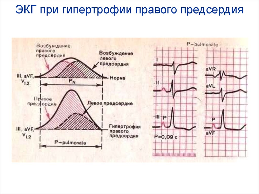 ЭКГ при гипертрофии правого предсердия