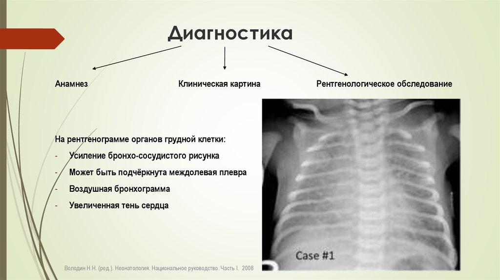 Усилен бронхо сосудистый рисунок