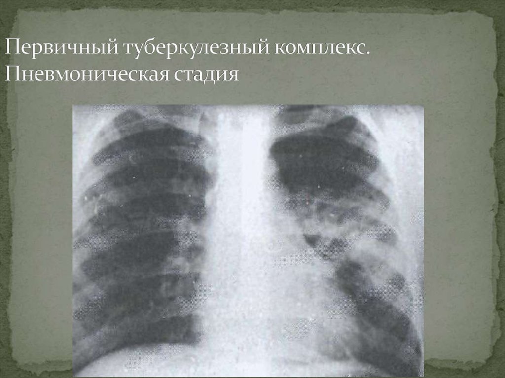 Первичный туберкулезный комплекс. Пневмоническая стадия