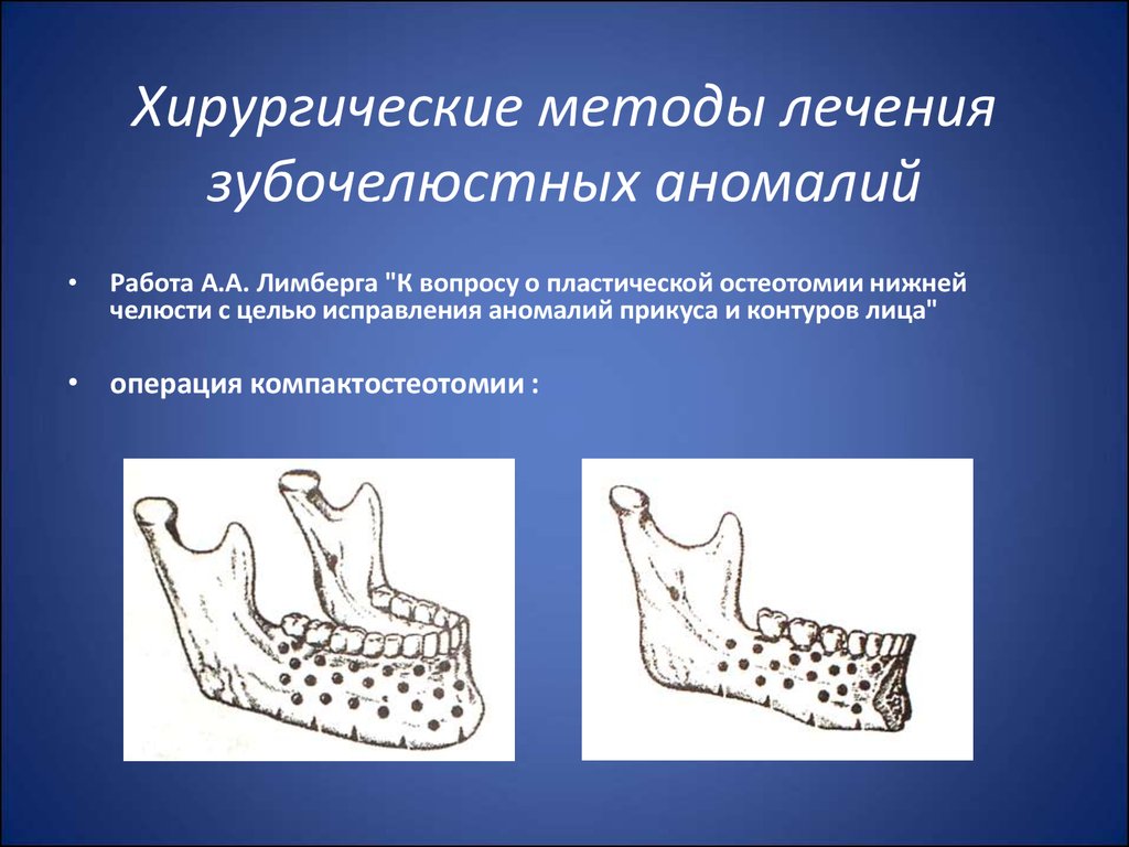 Оперативное лечение при аномалиях и деформациях верхней челюсти презентация