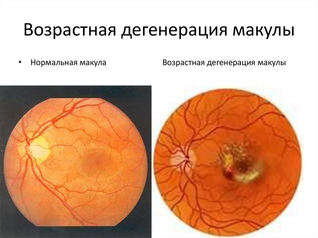 Наследственные дистрофии. Макулярная дегенерация сетчатки глаза. Возрастная макулодистрофия сетчатки. Макула дистрофия сетчатки глаза. Возрастная макулярная дистрофия сетчатки.
