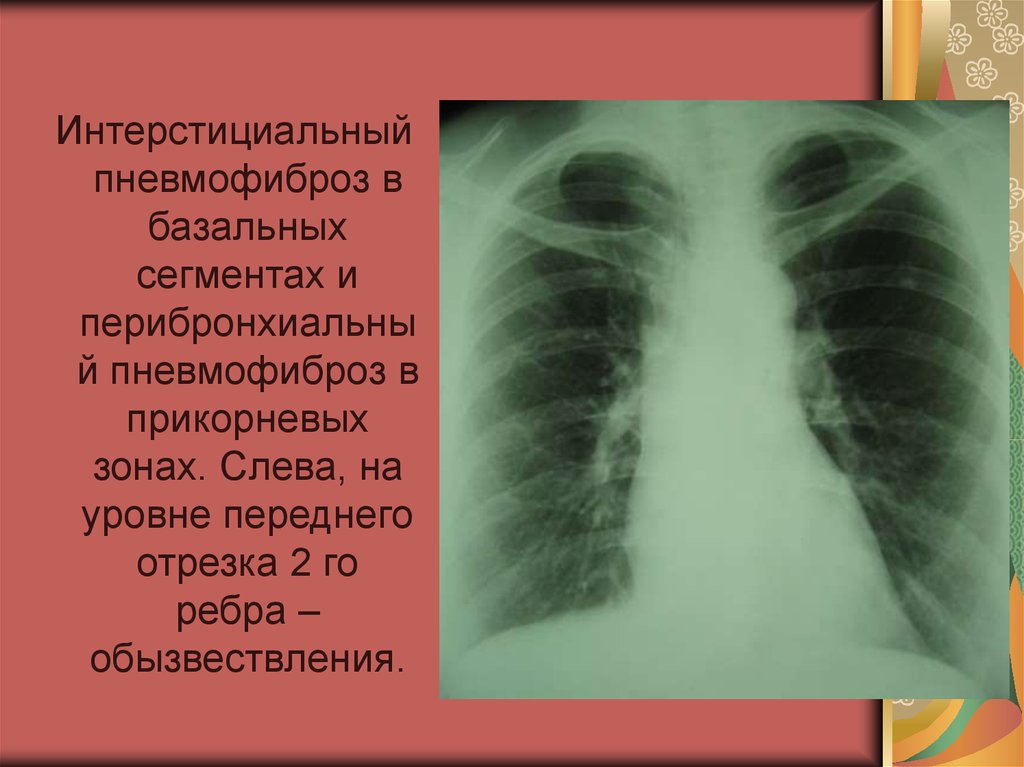 Легочный рисунок усилен в прикорневых отделах. Пневмофиброз s5 левого легкого. Пневмофиброз s5 правого лёгкого. Поражение легких при системной склеродермии.