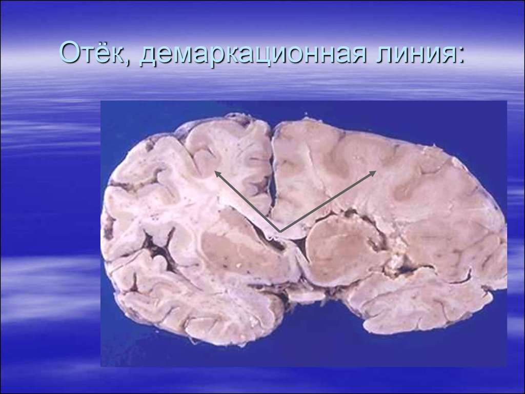 Инфаркт мозга неуточненный. Ишемический инсульт мозг макропрепарат. Отек мозга патанатомия макропрепарат. Отек головного мозга макропрепарат. Отёк головного мозга патологическая анатомия.