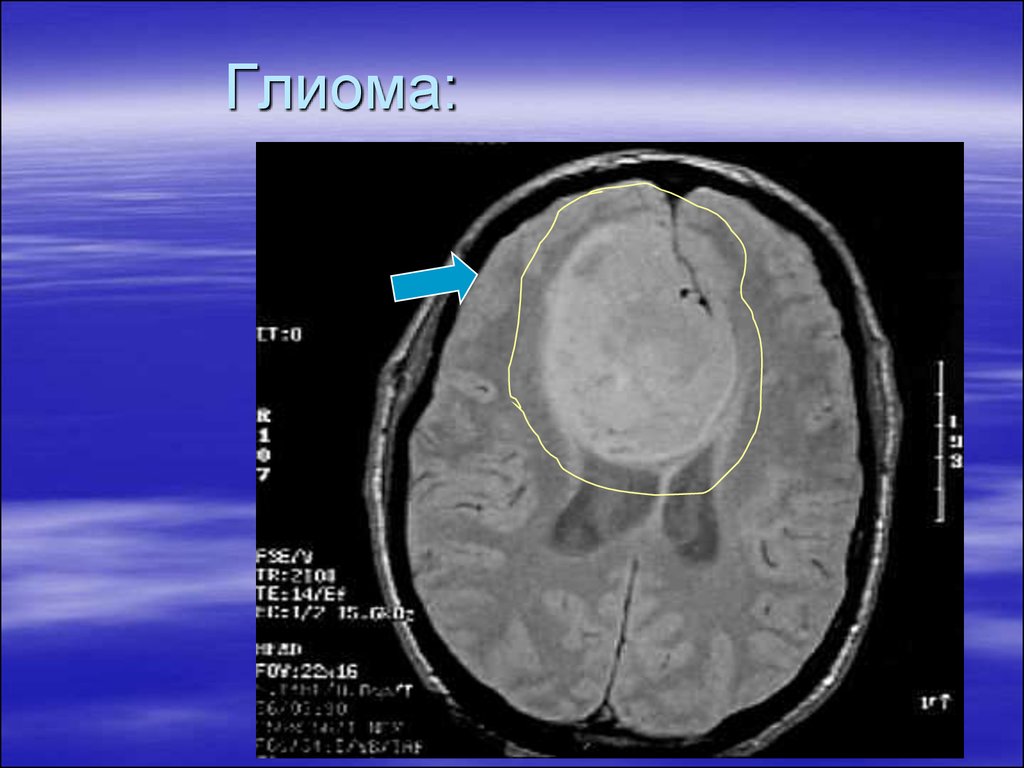 Глиома мозга. Глиома мозолистого тела. Опухоль головного мозга глиома.