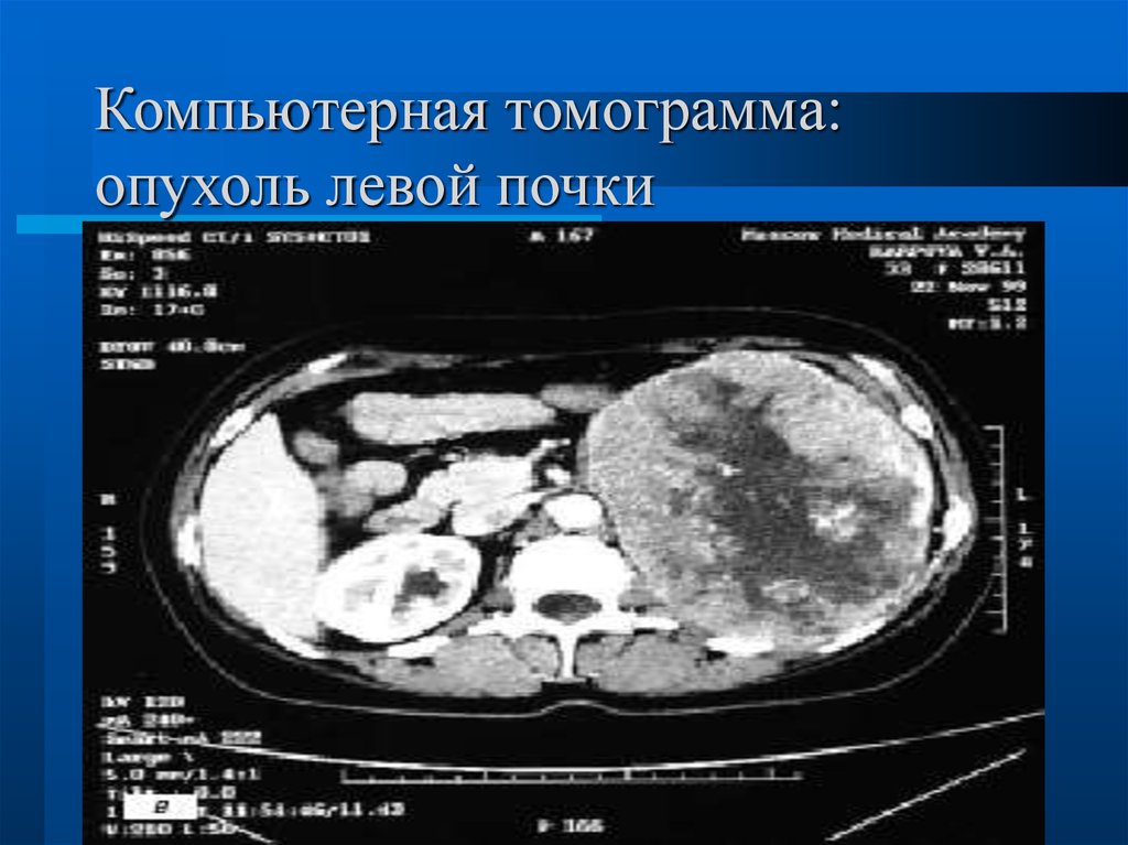 Кт картина са левой почки