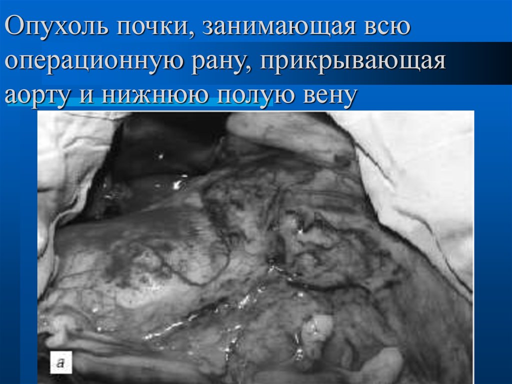 Опухоль почки, занимающая всю операционную рану, прикрывающая аорту и нижнюю полую вену