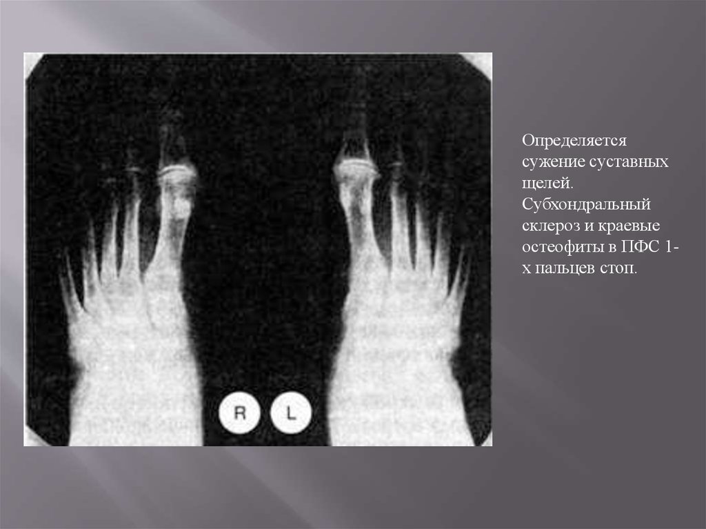 Склероз и краевые остеофиты. Субхондральный склероз рентген стоп. Субхондральный склероз суставных поверхностей на рентгене. Субхондральный склероз локтевой кости. Субхондральный склероз суставных поверхностей стопы.