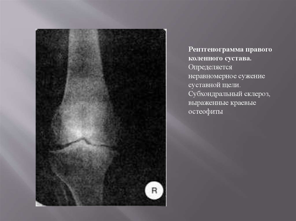 Субхондральный остеосклероз. Остеофиты коленного сустава рентген. Рентген суставной щели коленного сустава. Субхондральный склероз рентген. Рентгенограмма правого коленного сустава.