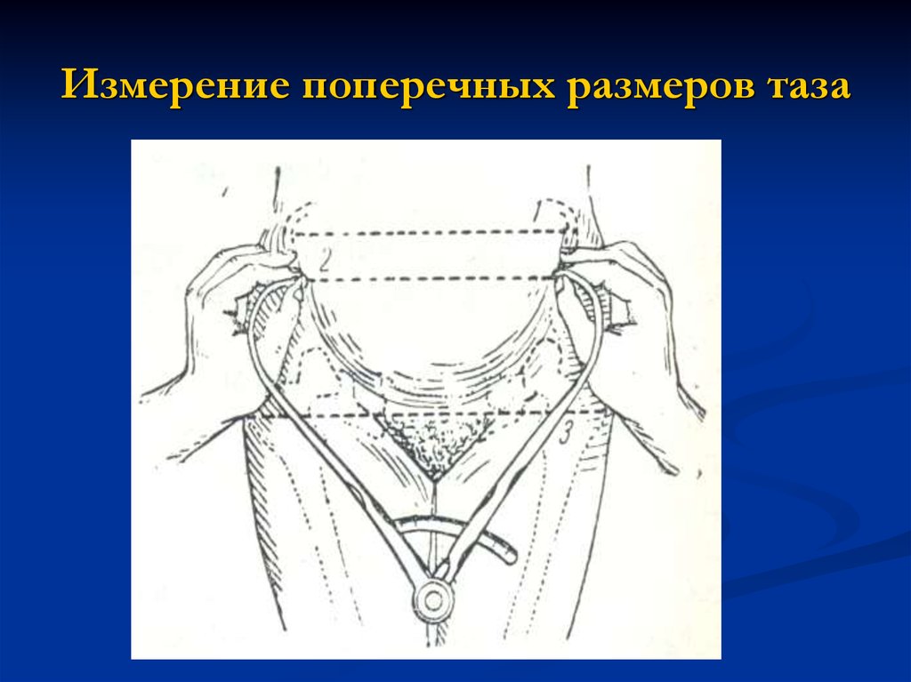 Таз индекс соловьева