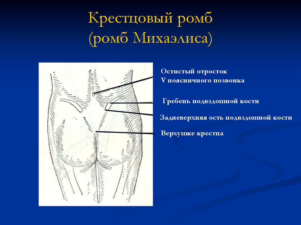 Нижний соответствующий. Измерение ромба Михаэлиса. Измерение пояснично крестцового ромба Михаэлиса. Крестец Михаэлиса. Длинник ромба Михаэлиса.