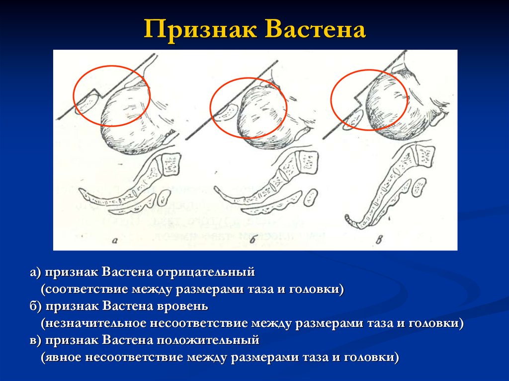 Узкий таз у женщин фото