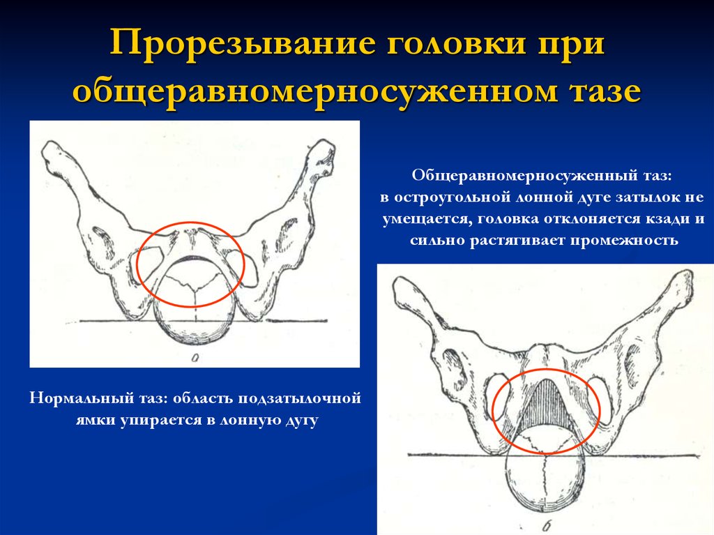 Стенками малого таза