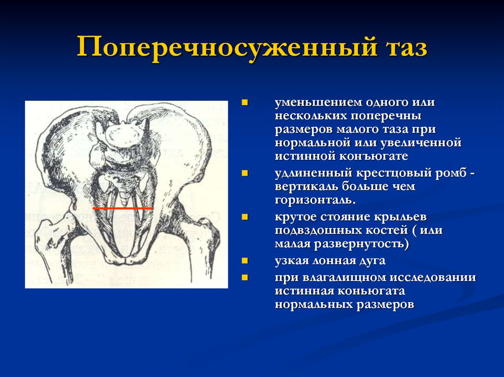 Аномалии таза презентация