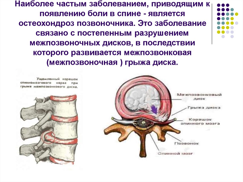 Может ли грыжа позвоночника. Грыжи позвоночника в поясничном отделе схема. Грыжа позвоночника разрез сбоку. Грыжа межпозвоночного диска причины. Заболевание позвоночника протрузия.