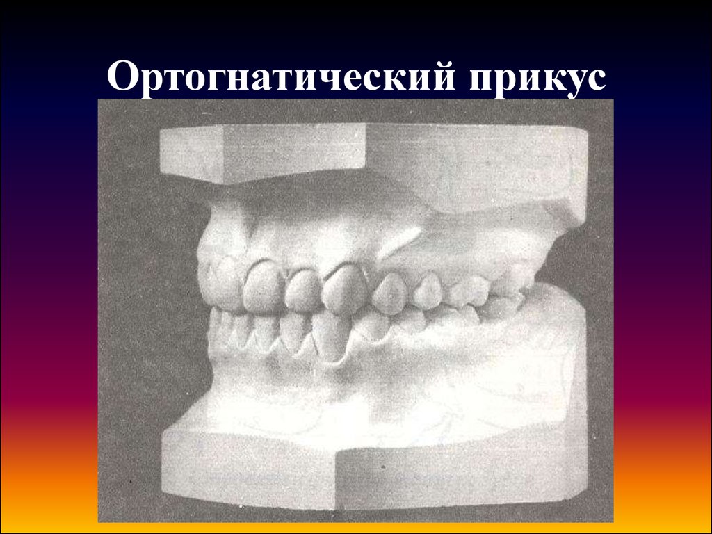 Прямой прикус картинка