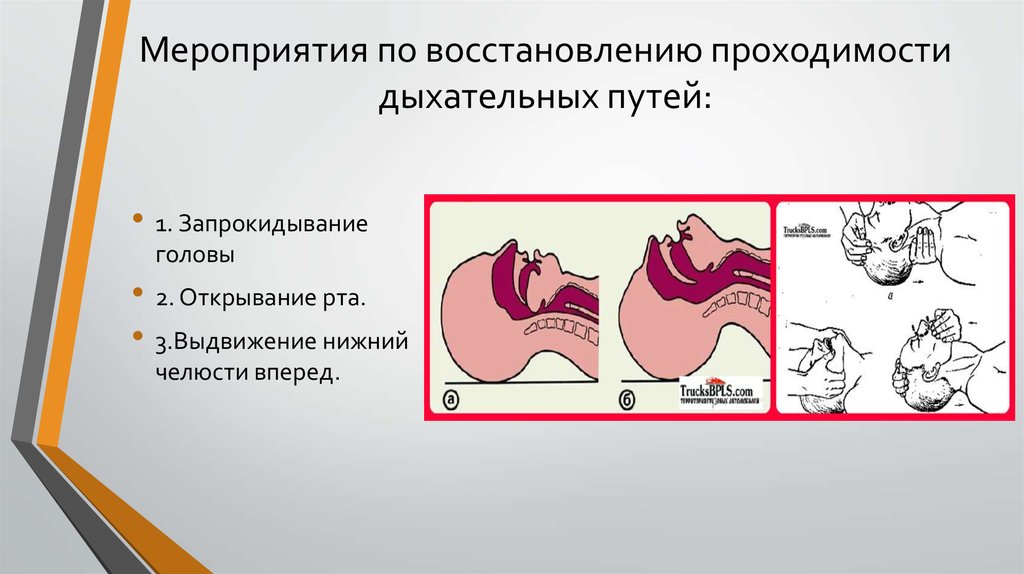 Восстановление дыхательных путей. Восстановление проходимости дыхательных путей. Мероприятия по проходимости дыхательных путей. Восстановление проходимости дыхательных путей алгоритм. Мероприятия по поддержанию проходимости дыхательных путей.