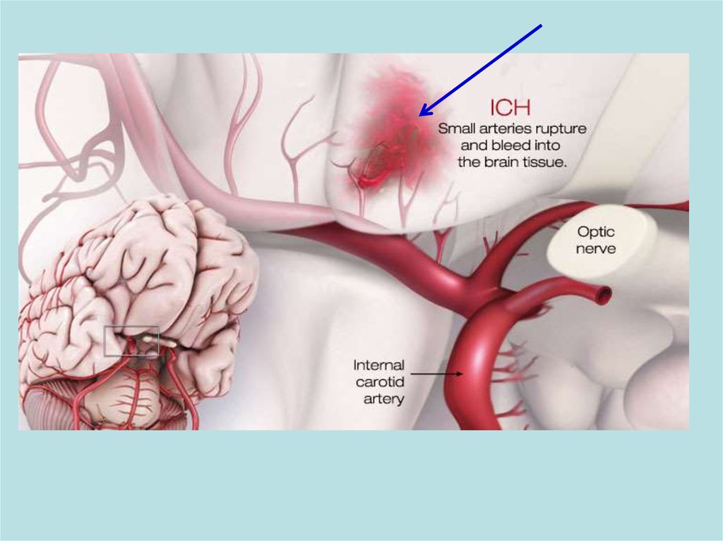 Цереброваскулярная болезнь. Цереброваскулярная артерия.