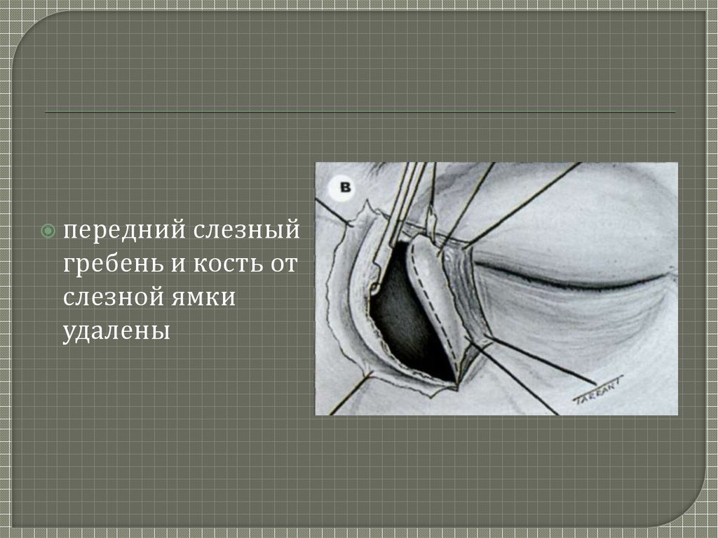 Передний гребень. Передний слезный гребень. Передний слезный гребешок. Передний и задний слезный гребень. Слезная кость ямка слезного мешка.